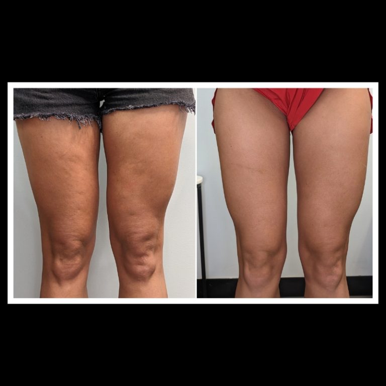 800x800 b4 and after cryo website (11)