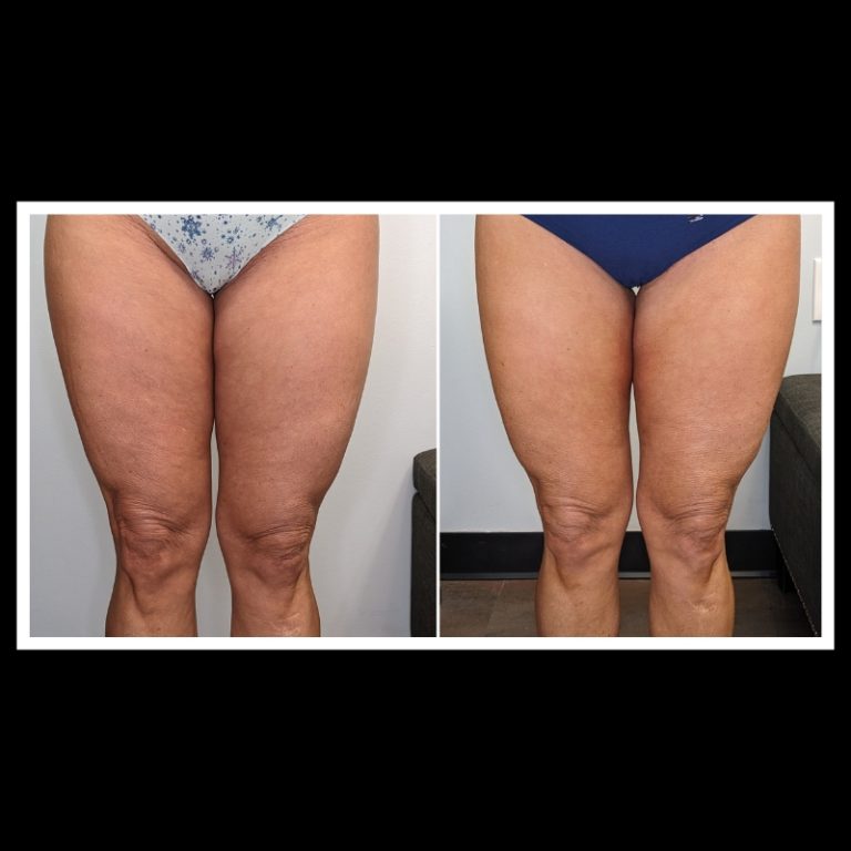 800x800 b4 and after cryo website (12)