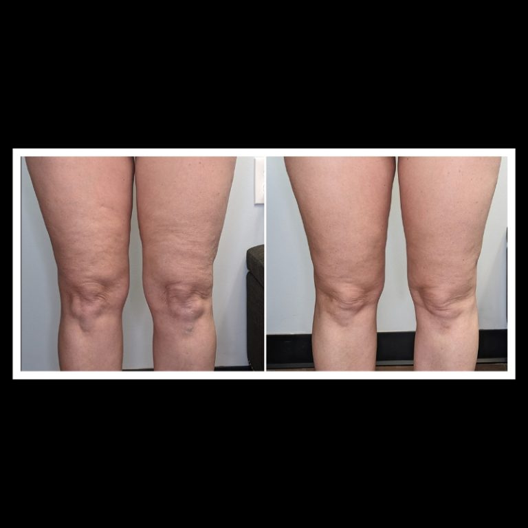 800x800 b4 and after cryo website (13)