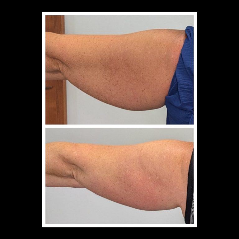 800x800 b4 and after cryo website (14)