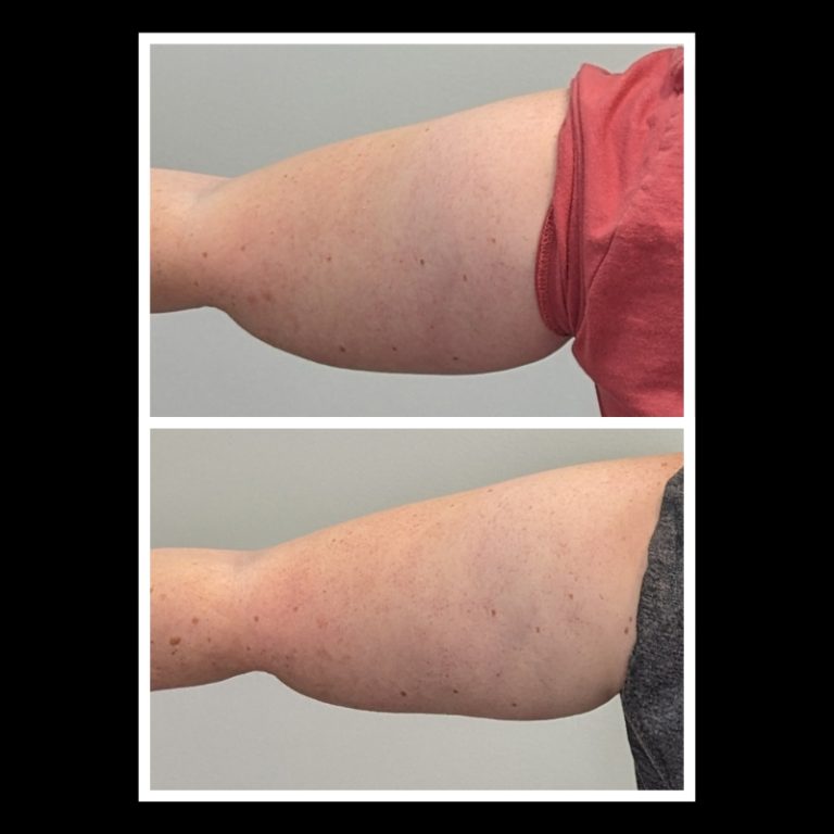 800x800 b4 and after cryo website (16)