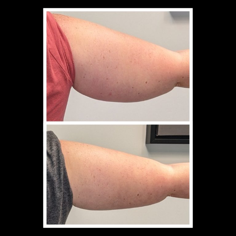 800x800 b4 and after cryo website (17)