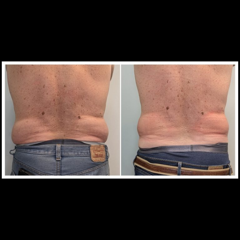 800x800 b4 and after cryo website (19)