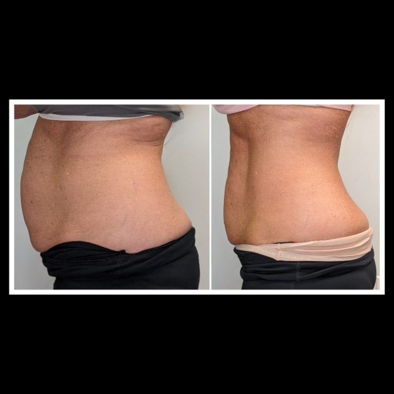 800x800 b4 and after cryo website (2)