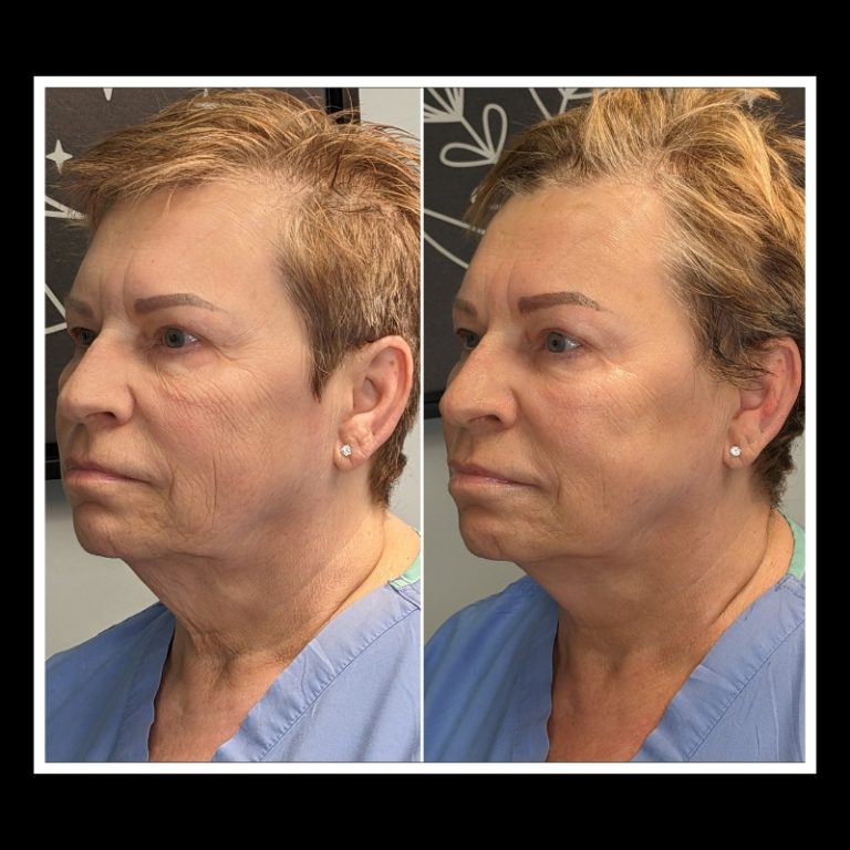 800x800 b4 and after cryo website (21)