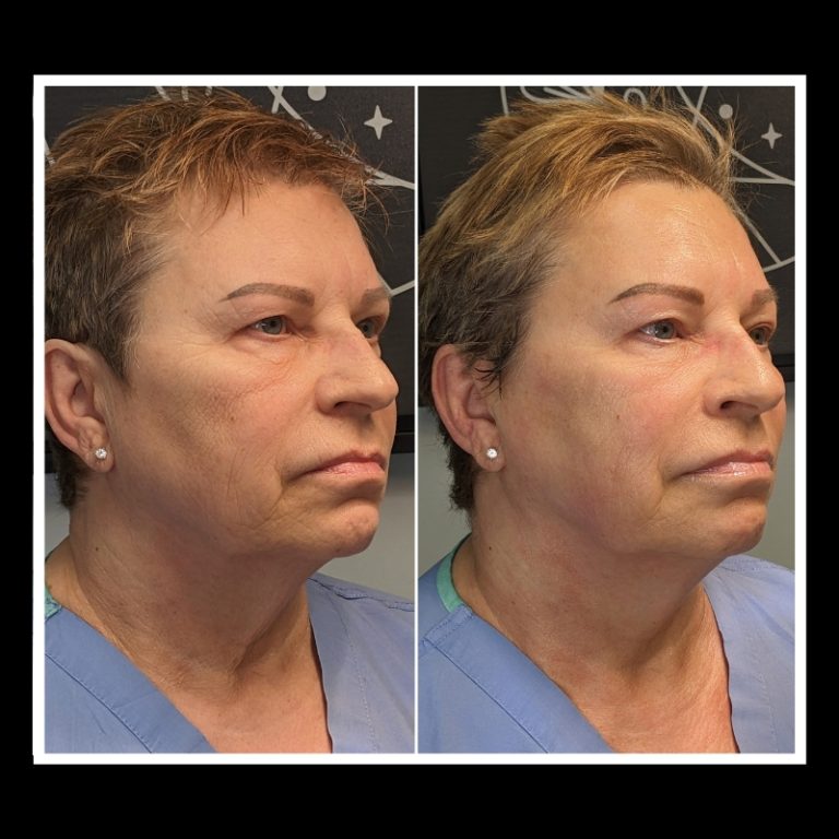 800x800 b4 and after cryo website (22)