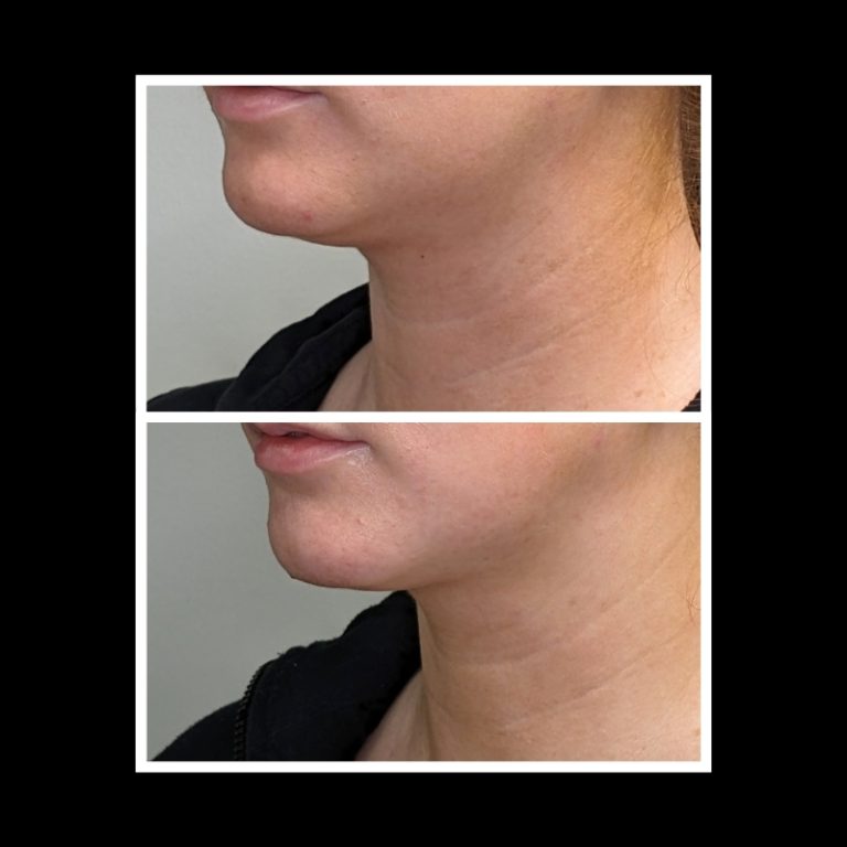 800x800 b4 and after cryo website (24)