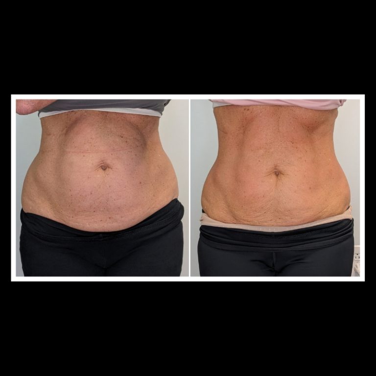 800x800 b4 and after cryo website (3)