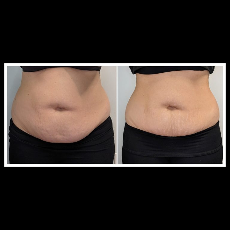 800x800 b4 and after cryo website (4)