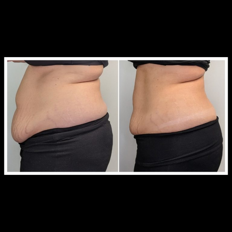 800x800 b4 and after cryo website (5)