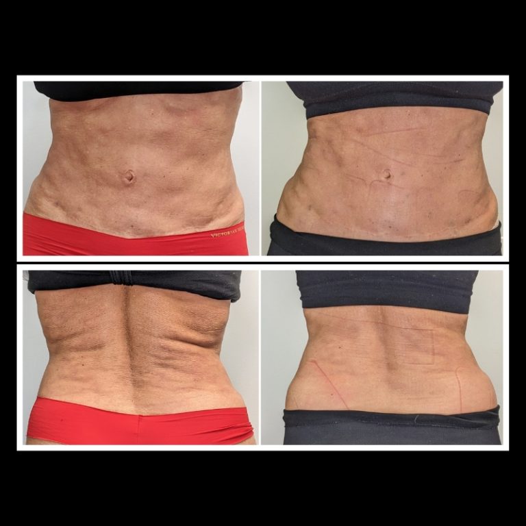 800x800 b4 and after cryo website (6)