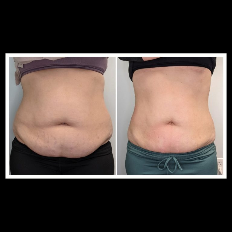 800x800 b4 and after cryo website (7)