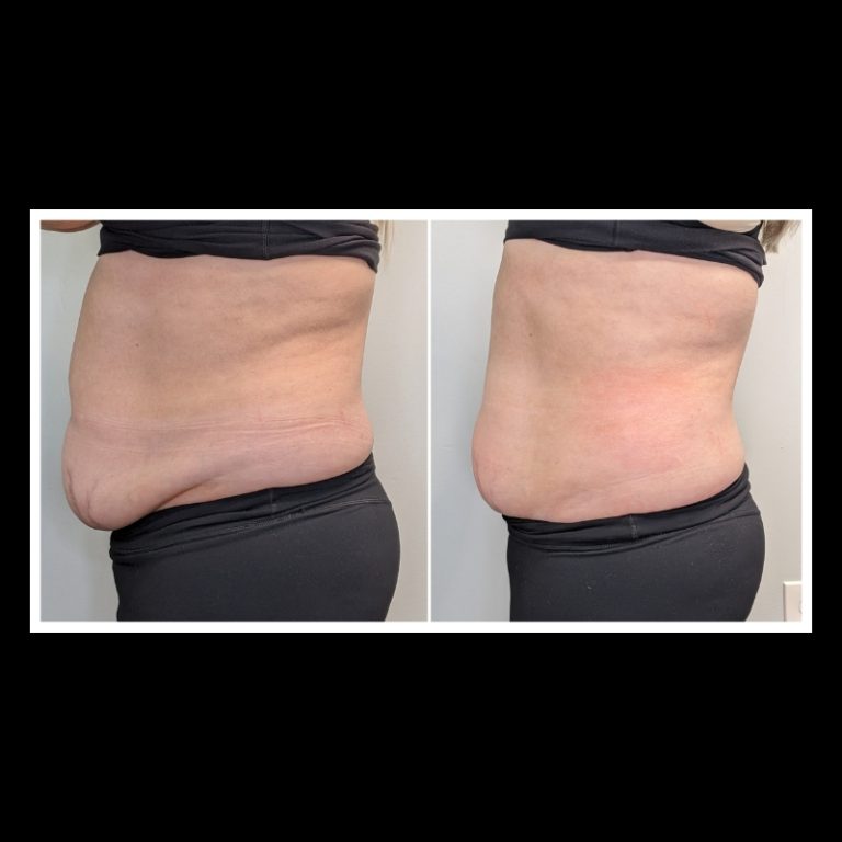 800x800 b4 and after cryo website