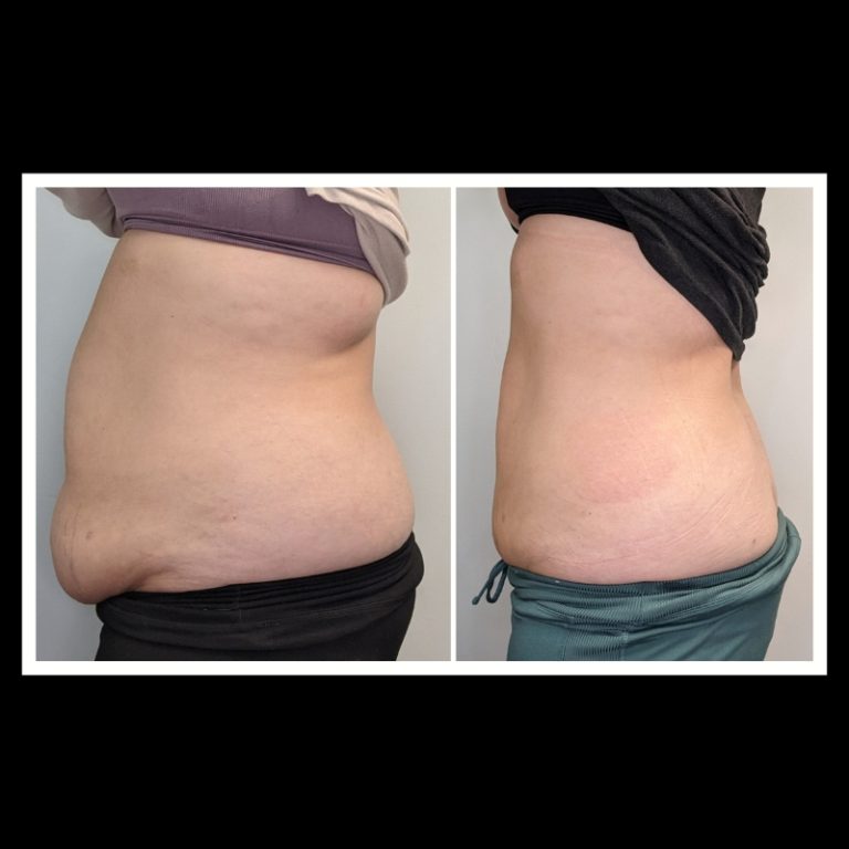 800x800 b4 and after cryo website (8)