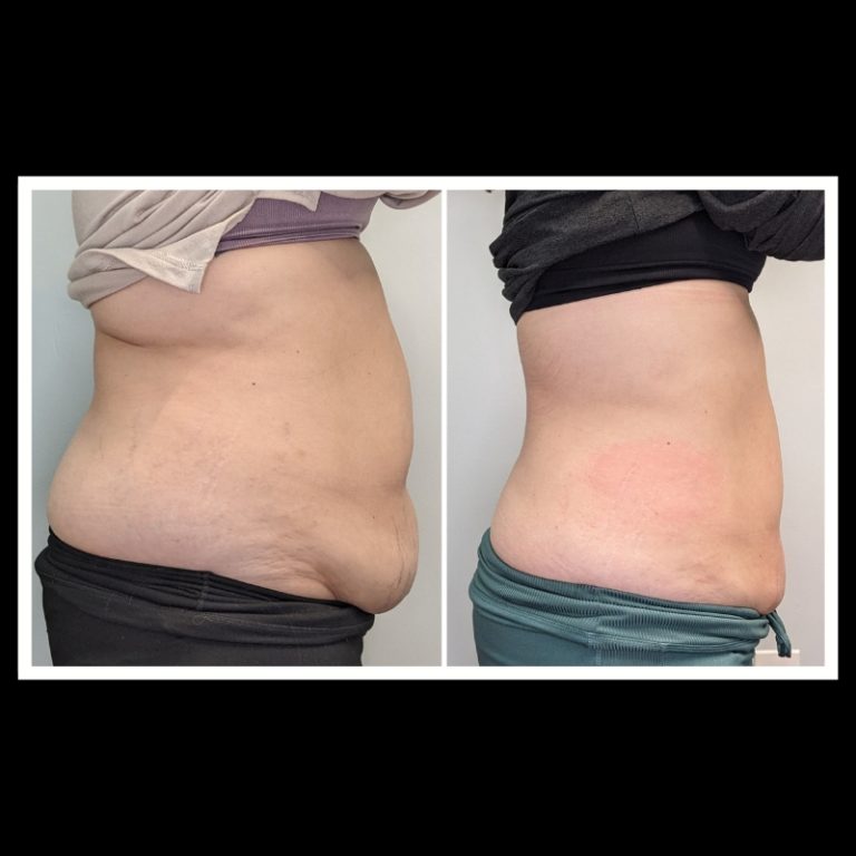 800x800 b4 and after cryo website (9)