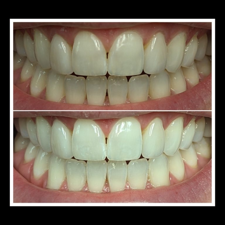 Before and After's Whitening (1)