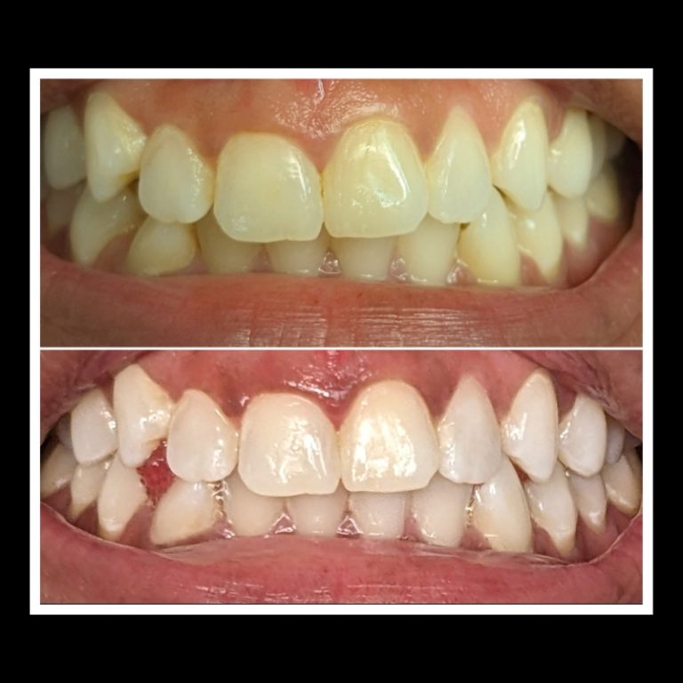 Before and After's Whitening (2)