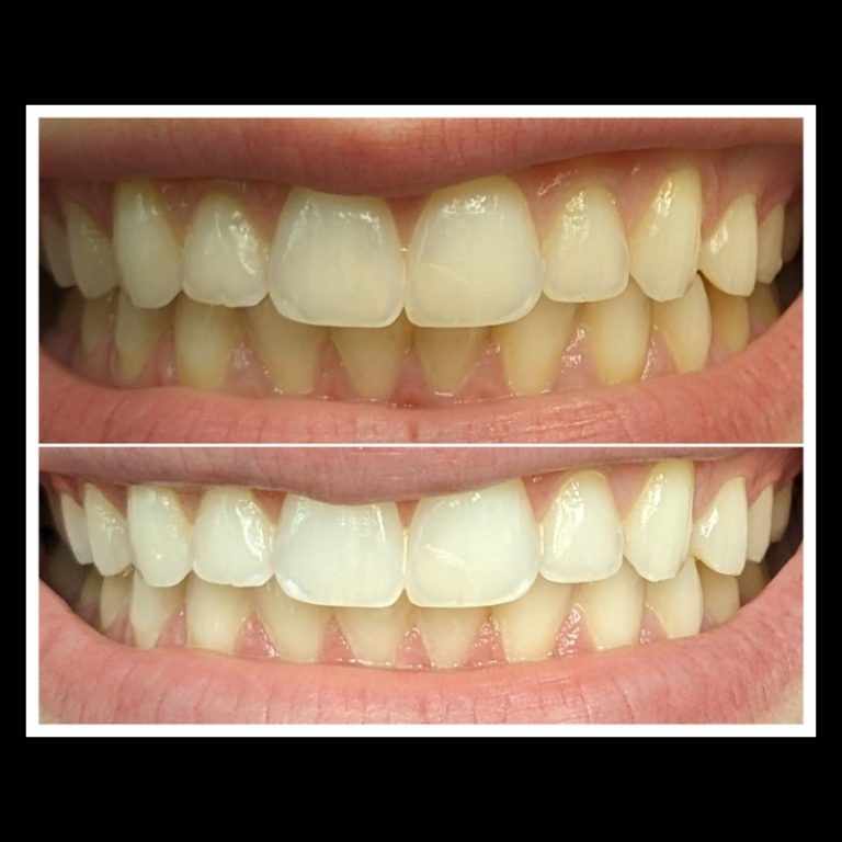 Before and After's Whitening (3)