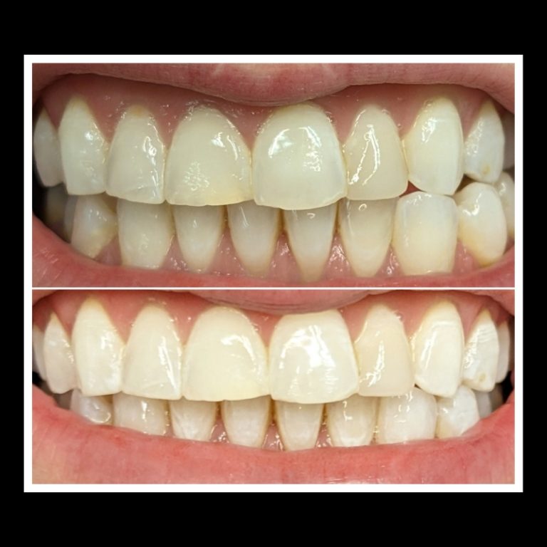 Before and After's Whitening